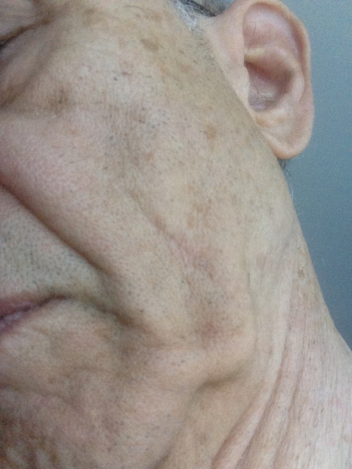 My scar today just short of 12 months after the operation