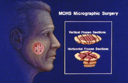 This is how Mohs surgery works.